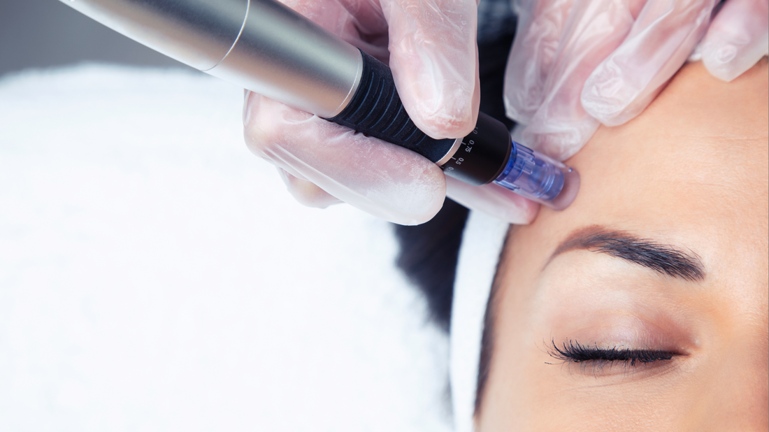 Microneedling